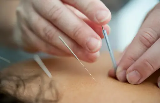 Consulta de Acupuntura